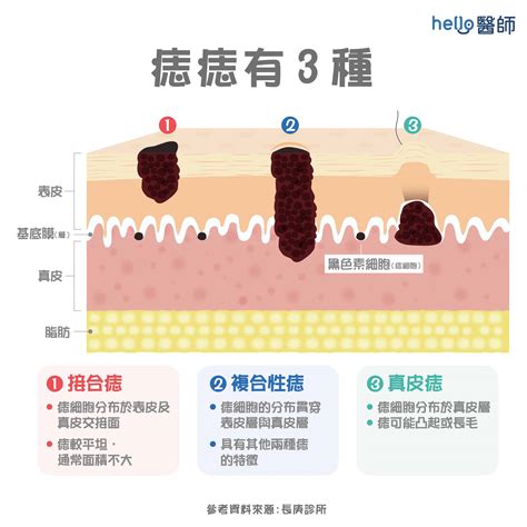 為什麼會長痣|痣變大、痣多或長毛會變皮膚癌？認識痣的形成與原因